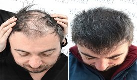 Best-Hair-Transplant before after