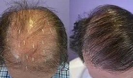 Best-Hair-Transplant in Islamabad
