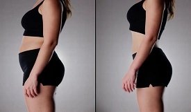 Best Liposuction in Pakistan