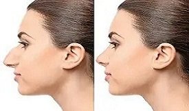 Best Rhinoplasty in Islamabad