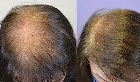 Hair-Transplant before after