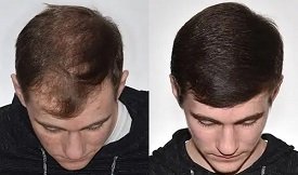 Hair-Transplant cost in Islamabad