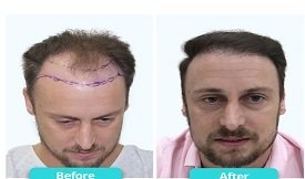 Hair-Transplant in Pakistan