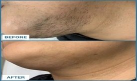 Laser hair removal before after results