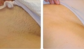 Laser hair removal before after