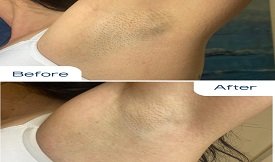 Laser hair removal cost in Islamabad