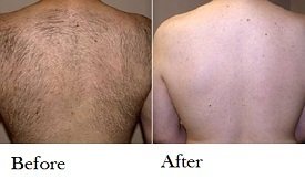 Laser hair removal cost in Pakistan