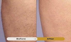 Laser hair removal in pakistan