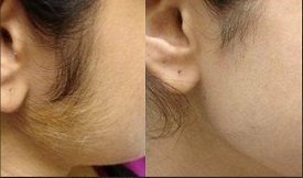 Laser hair removal treatment