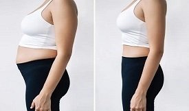 Liposuction surgery in Islamabad