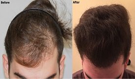 PRP hair therapy before after results