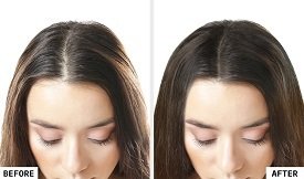 PRP hair therapy before after