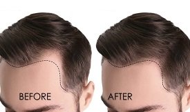 PRP therapy cost in Islamabad