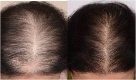 PRP therapy cost in Pakistan