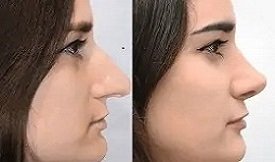 Rhinoplasty before after