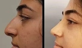 Rhinoplasty before after results