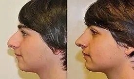 Rhinoplasty-before-after-resultss