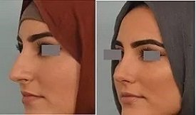 Rhinoplasty cost in Islamabad