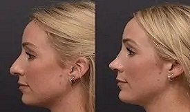 Rhinoplasty treatment in Islamabad