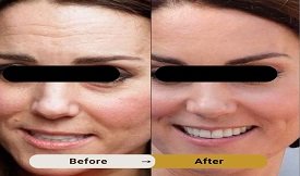 botox before after results