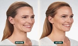 botox before after