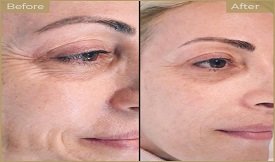 botox cost in Islamabad
