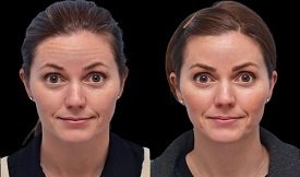 botox injection cost in Islamabad