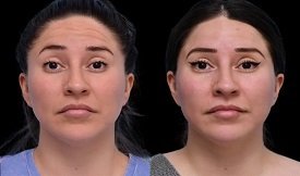 botox injection in Islamabad