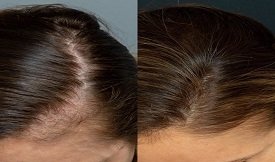 prp-hair-treatment in Islamabad