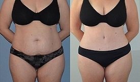 Best Tummy Tuck in Islamabad