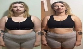Munjaro Injection before after result