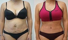 Tummy Tuck before after results