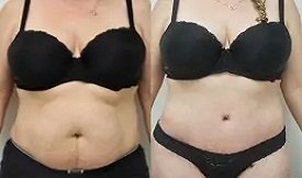 Tummy Tuck before after