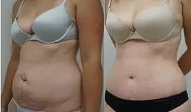Tummy Tuck cost in Islamabad