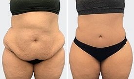 Tummy Tuck in Pakistan