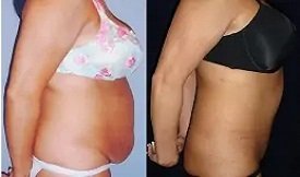 Tummy Tuck surgery in Islamabad