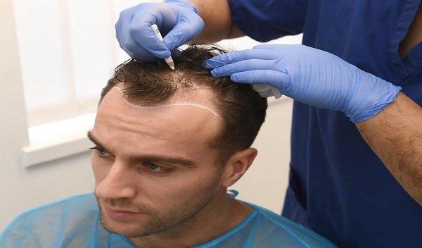 Hair Transplant surgery in Islamabad