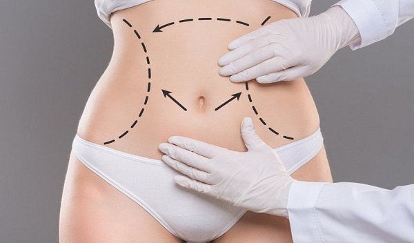 Liposuction in Islamabad