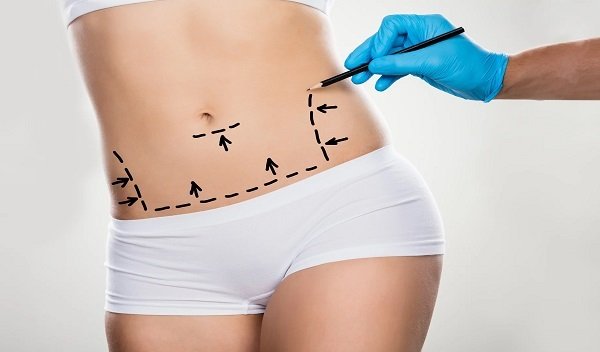 Tummy Tuck in Islamabad